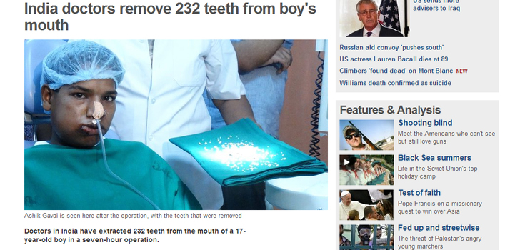 Pojalta poistettiin 232 hammasta | Intiassa ilmenneessä tapauksessa jouduttiin käyttämään erinäisiänlääketieteellisiä toimenpiteitä pojan terveydentilan parantamiseksi.